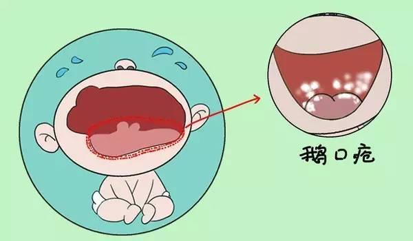 家长要注意宝宝嘴巴里有不明物体——鹅口疮？